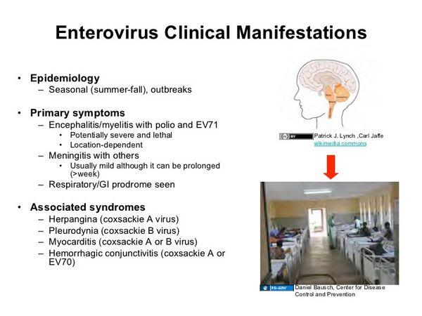 Enteroviruses Clinical Syndromes Viral Infections