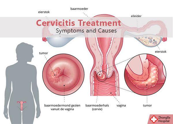 Cervicitis Cervicitis