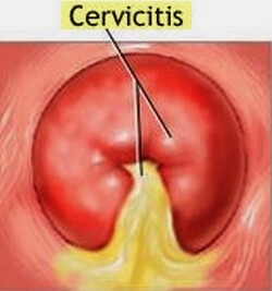Cervicitis Cervicitis