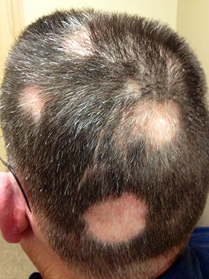 Tinea Capitis Tinea Capitis