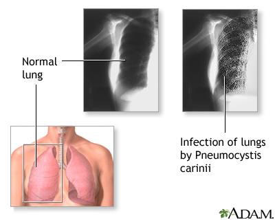 Pneumocystis jiroveci (Pneumocystis carinii) Pneumonia Pneumocystis jiroveci (Pneumocystis carinii) Pneumonia