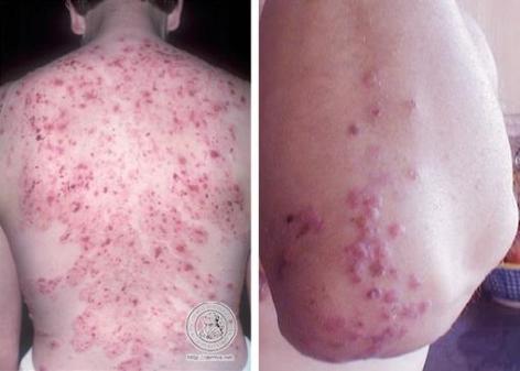 Dermatitis Herpetiformis Dermatitis Herpetiformis