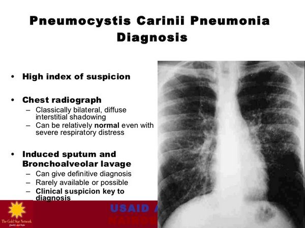 Pneumocystis jiroveci (Pneumocystis carinii) Pneumonia Pneumocystis jiroveci (Pneumocystis carinii) Pneumonia