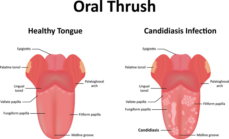 Oral Candidiasis Oral Thrush Fungal Infections AntiinfectiveMeds