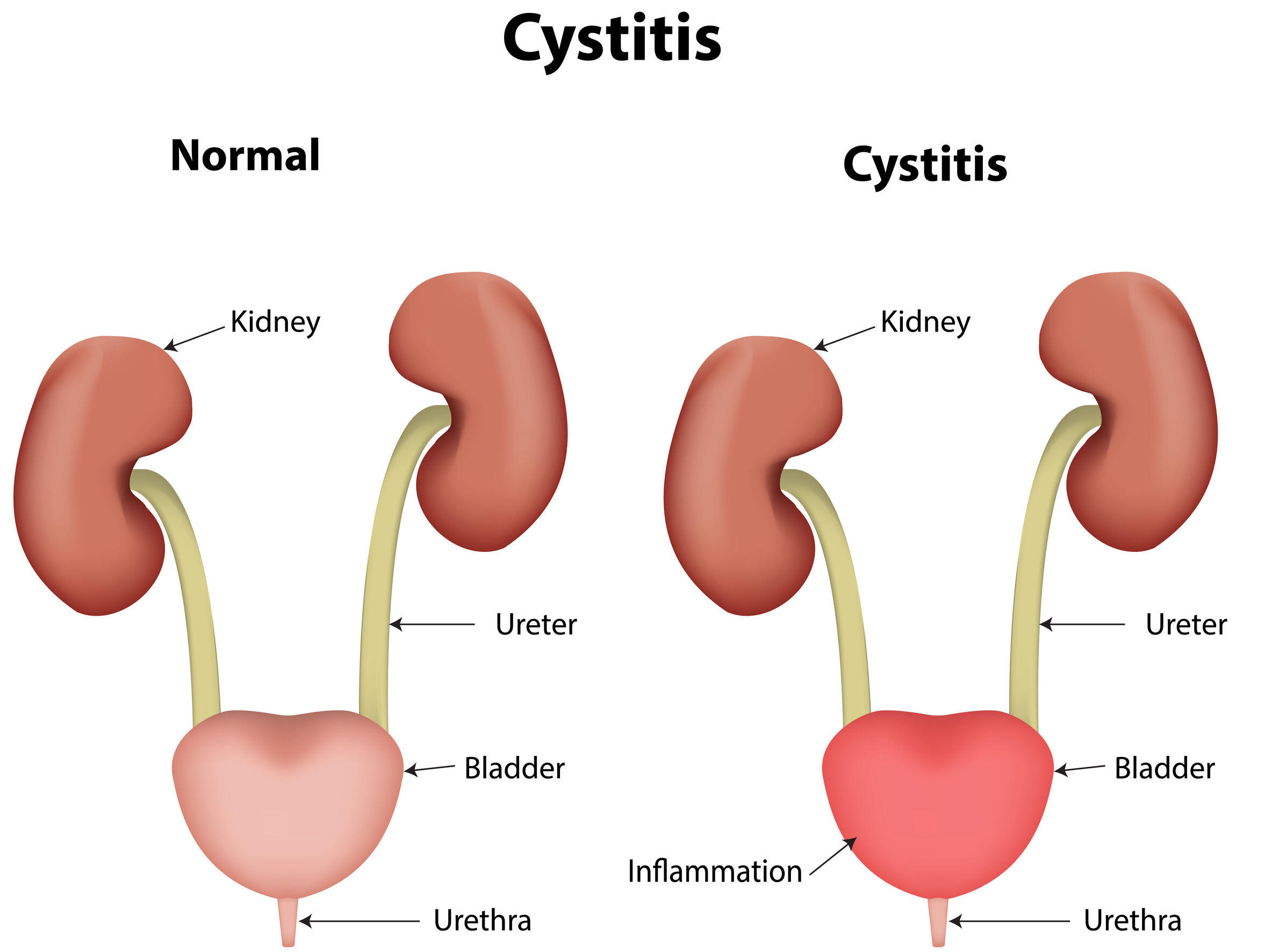 Candiduria Candida Cystitis Urinary Tract Candidiasis Fungal 