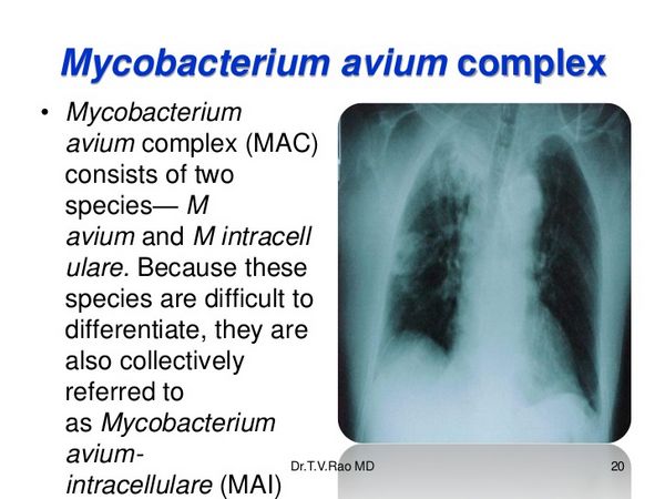 Mycobacterium Avium Complex Disseminated And Pulmonary Disease