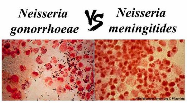 Neisseria Gonorrhoeae And Neisseria Meningitidis Bacterial Infections 3518