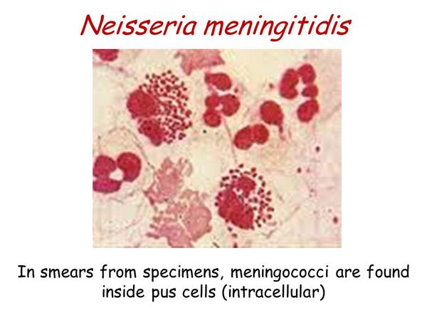 Neisseria Meningitidis - Bacterial Infections - AntiinfectiveMeds.com