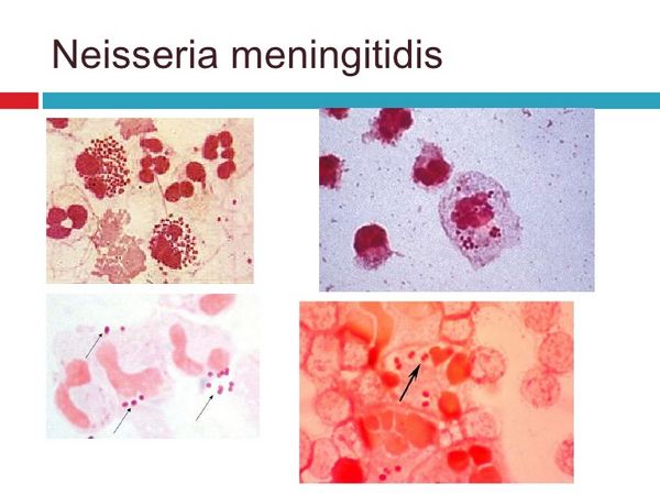 Neisseria Meningitidis - Bacterial Infections - AntiinfectiveMeds.com