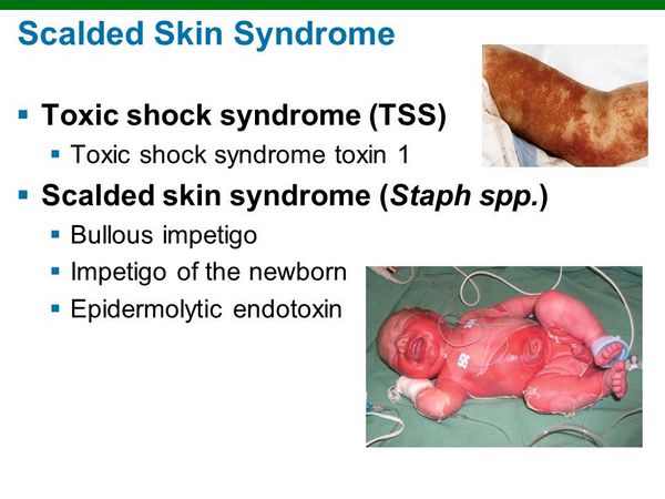 Scalded Skin Staph Infection