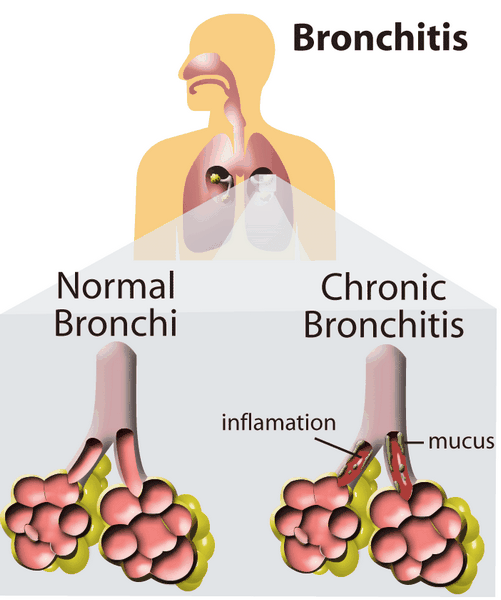 Acute Exacerbations Of Chronic Bronchitis: Current Therapies 