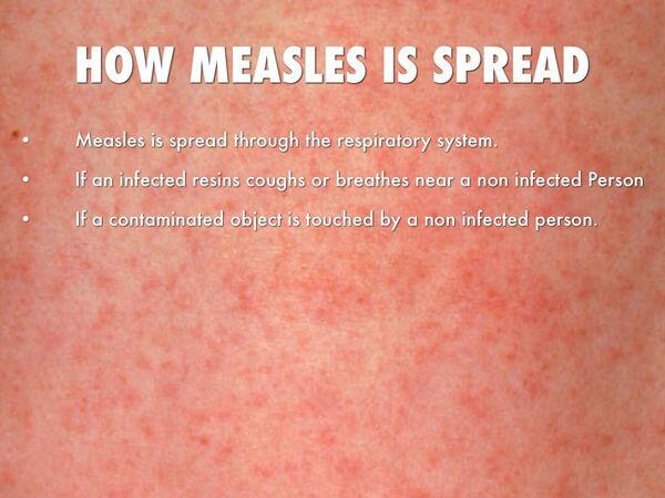 Measles - Viral Infections - AntiinfectiveMeds.com