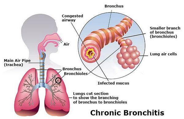 Who Gets Chronic Bronchitis? - Bronchitis - AntiinfectiveMeds.com